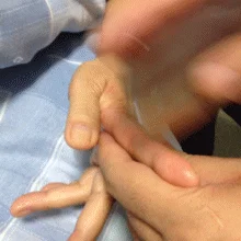 轻刮2手指治痔疮