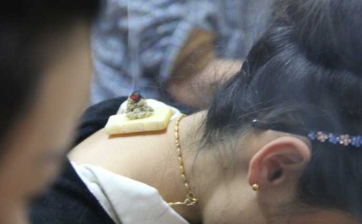 慢性萎缩性胃炎的阴虚夹湿证