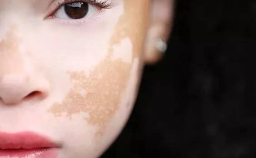 中医对白癜风的饮食疗法